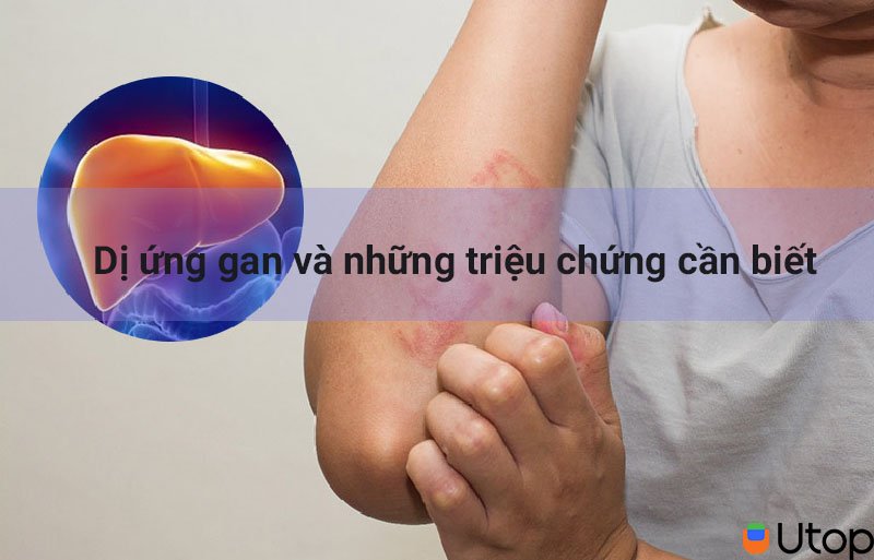 Dị ứng gan và những triệu chứng cần biết